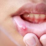 Cara Cepat Menghilangkan Sariawan, Panduan Lengkap dan Efektif
