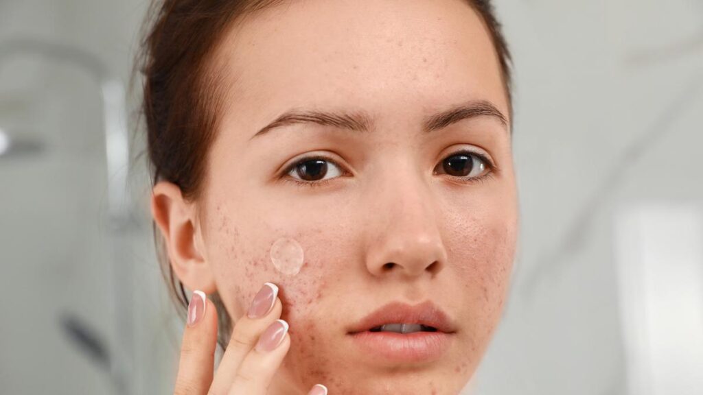 Cara Pakai Acne Patch yang Benar agar Jerawat Cepat Kering