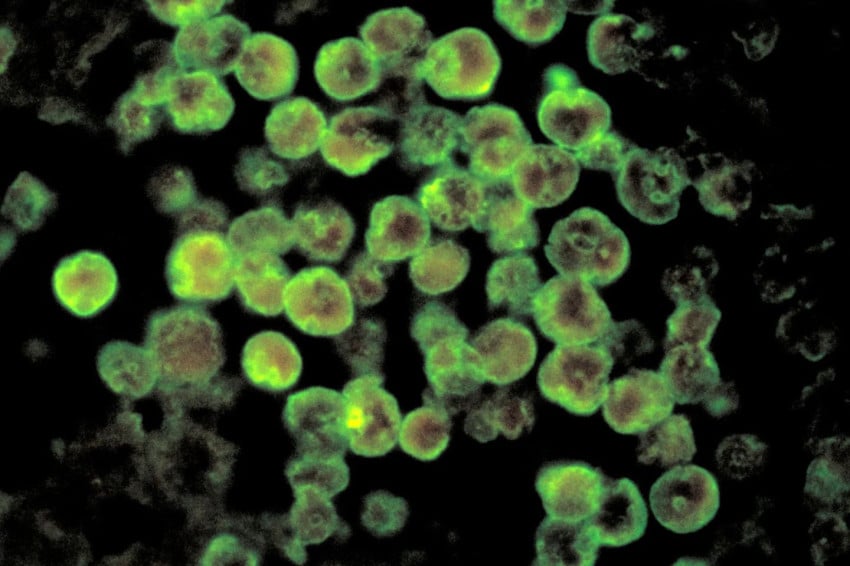 India Darurat Kasus Amoeba Pemakan Otak, Begini Cara Penyebaran dan Gejalanya