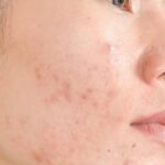 Rahasia Kulit Mulus, Ini Cara Ampuh Menghilangkan Jerawat Merah di Pipi