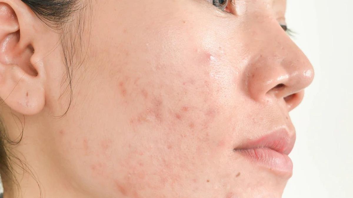 Rahasia Kulit Mulus, Ini Cara Ampuh Menghilangkan Jerawat Merah di Pipi