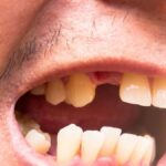 Mimpi Gigi Rontok Semua? Ini Arti dan Makna Tersembunyinya