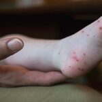 Ini Penyebab Hingga Perawatan Flu Singapura yang Perlu Anda Ketahui