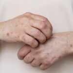 6 Masalah Kulit yang Perlu Diwaspadai Saat Musim Hujan dan Banjir