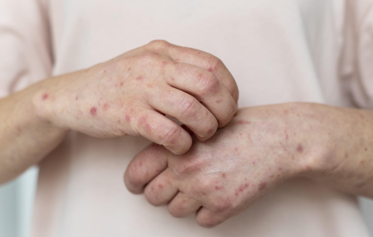 6 Masalah Kulit yang Perlu Diwaspadai Saat Musim Hujan dan Banjir